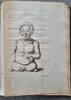 Another image of PUELLAE MONSTROSAE DELINEATIO, by [TERATOLOGY.] CAMPEN, Michael Johan van.
